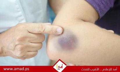 ظهور الكدمات على الجسم دون سبب واضح - تفاصيل